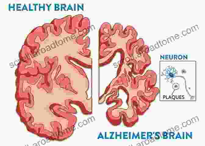 A Healthy Brain Surrounded By Protective Elements, Representing The Power Of Prevention Against Alzheimer's, Dementia, And Memory Loss. A Healthy Brain For Life: How To Prevent Alzheimer S Dementia And Memory Loss