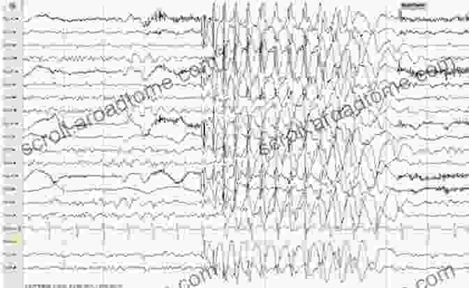 EEG Interpretation In A Case Of Epilepsy Practical Approach To Electroencephalography Mark H Libenson